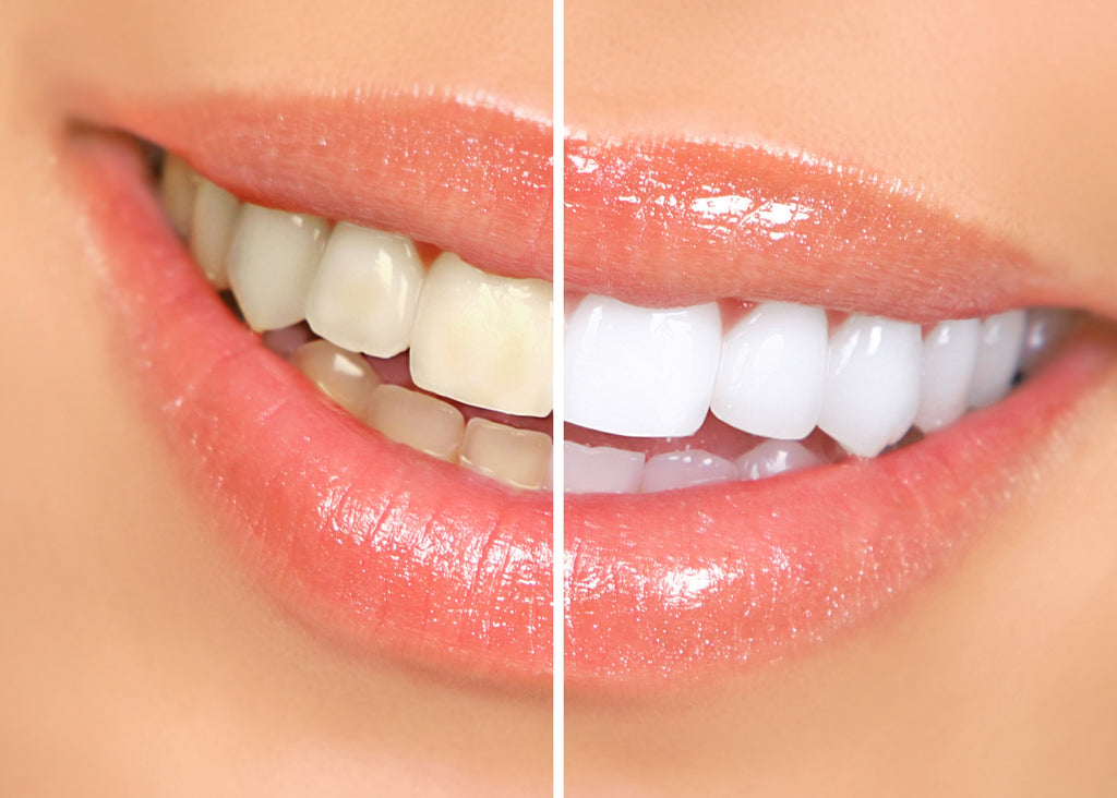 Is Teeth Whitening Safe to Use?